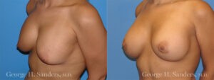 Patient 1c Breast Capsules Before and After