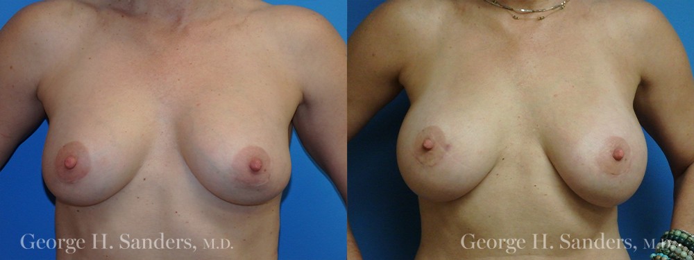 Patient 10a Breast Capsules Before and After