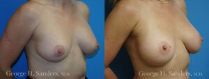 Patient 10b Breast Capsules Before and After