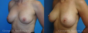 Patient 10c Breast Capsules Before and After