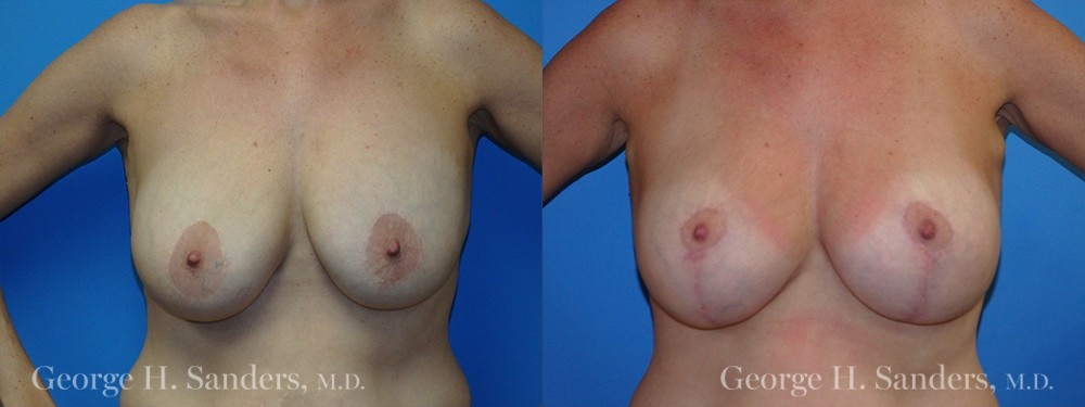 Patient 11a Breast Capsules Before and After