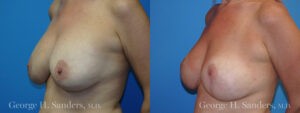 Patient 11b Breast Capsules Before and After