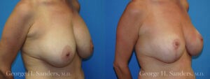 Patient 11c Breast Capsules Before and After