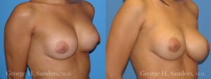 Patient 2b Breast Capsules Before and After