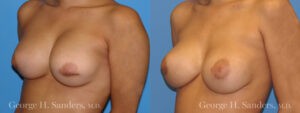 Patient 2c Breast Capsules Before and After
