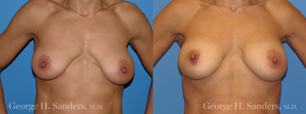 Patient 3a Breast Capsules Before and After