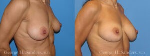 Patient 3b Breast Capsules Before and After