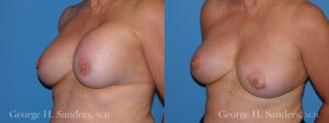 Patient 4c Breast Capsules Before and After