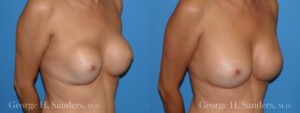 Patient 5b Breast Capsules Before and After