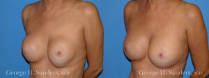 Patient 5c Breast Capsules Before and After