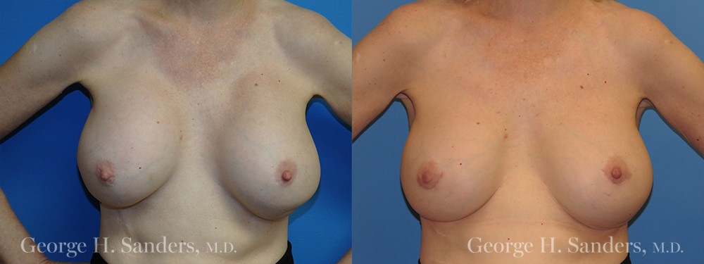 Patient 6a Breast Capsules Before and After