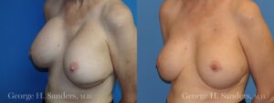 Patient 6b Breast Capsules Before and After