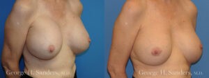 Patient 6c Breast Capsules Before and After