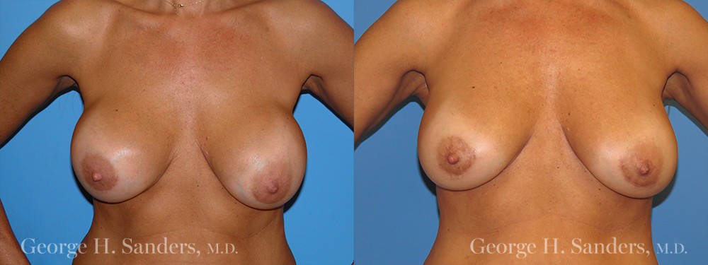 Patient 7a Breast Capsules Before and After