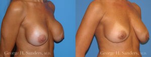 Patient 7b Breast Capsules Before and After
