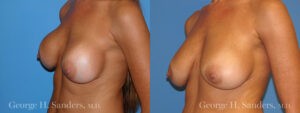 Patient 7c Breast Capsules Before and After