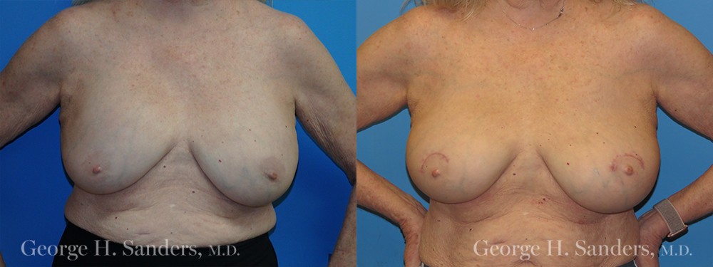 Patient 8a Breast Capsules Before and After