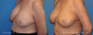 Patient 8b Breast Capsules Before and After