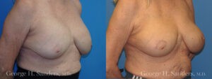 Patient 8c Breast Capsules Before and After