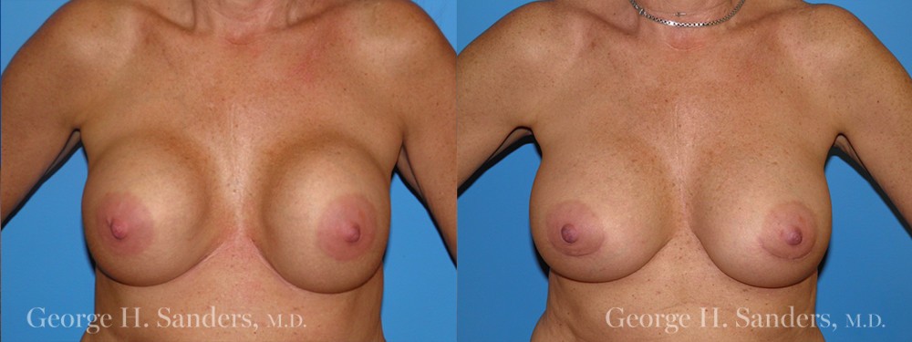 Patient 9a Breast Capsules Before and After
