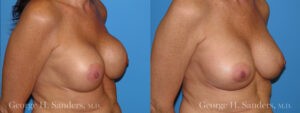 Patient 9b Breast Capsules Before and After