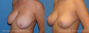 Patient 1b Breast Reduction Before and After