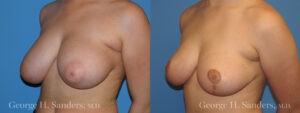 Patient 2b Breast Reduction Before and After