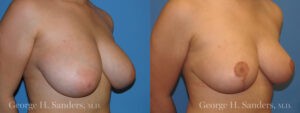 Patient 2c Breast Reduction Before and After