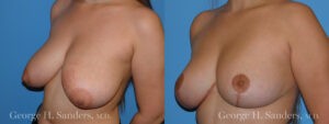 Patient 5c Breast Reduction Before and After
