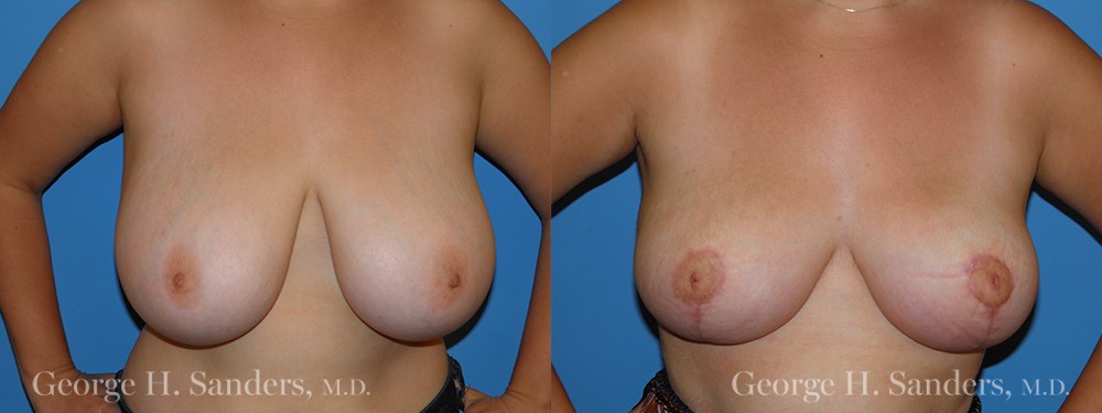 Patient 6a Breast Reduction Before and After