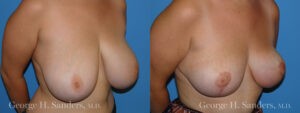 Patient 6b Breast Reduction Before and After
