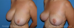 Patient 6c Breast Reduction Before and After