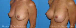 Patient 1b Breast Augmentation Before and After