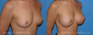 Patient 2c Breast Augmentation Before and After