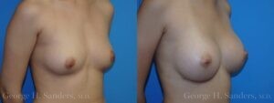 Patient 3b Breast Augmentation Before and After