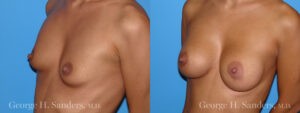 Patient 4b Breast Augmentation Before and After