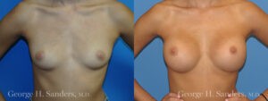 Patient 5a Breast Augmentation Before and After