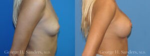 Patient 5c Breast Augmentation Before and After