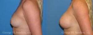 Patient 6c Breast Augmentation Before and After