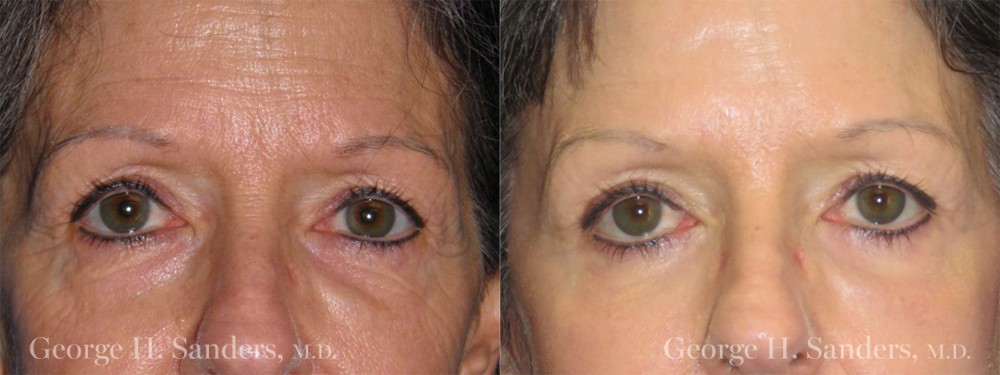 Patient 1a Brow Lift Before and After