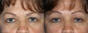 Patient 2b Brow Lift Before and After