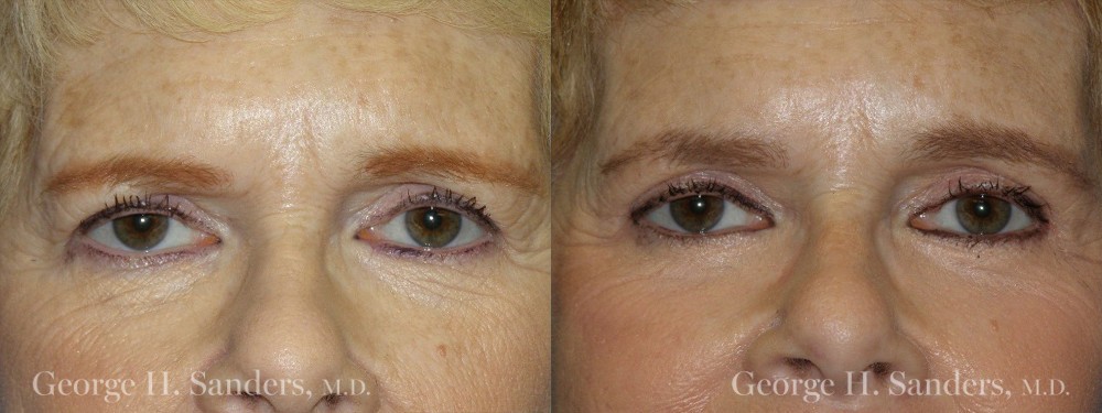Patient 4a Brow Lift Before and After