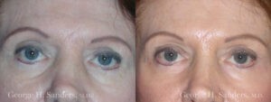 Patient 5a Brow Lift Before and After