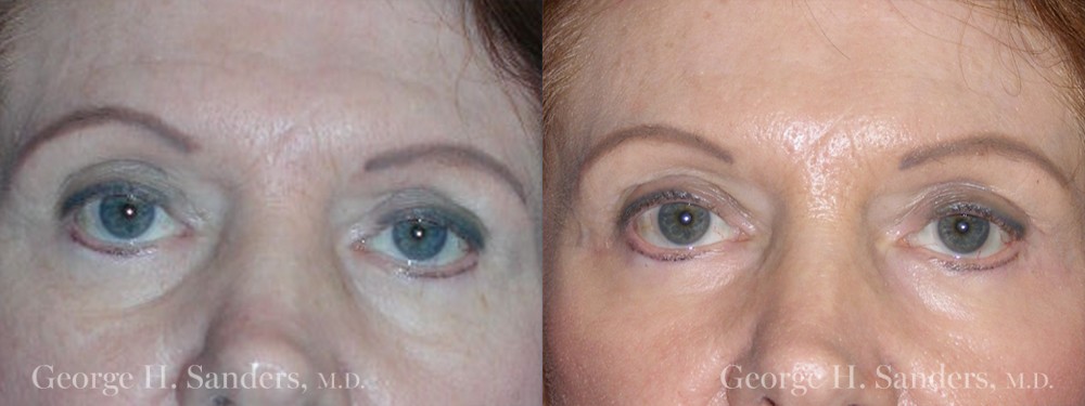 Patient 5a Brow Lift Before and After
