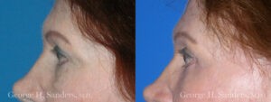 Patient 5b Brow Lift Before and After