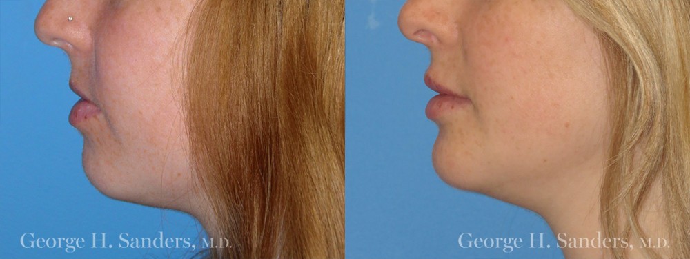 Patient 3a Chin Augmentation Before and After