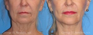 Patient 4c Chin Augmentation Before and After