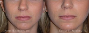 Patient 5b Chin Augmentation Before and After