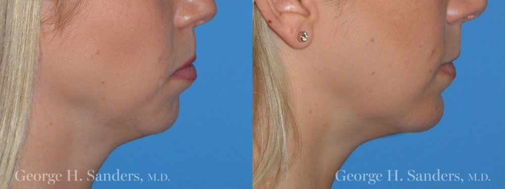Patient 5a Chin Augmentation Before and After