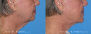 Patient 6b Chin Augmentation Before and After